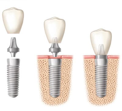 A diagram of dental implants.