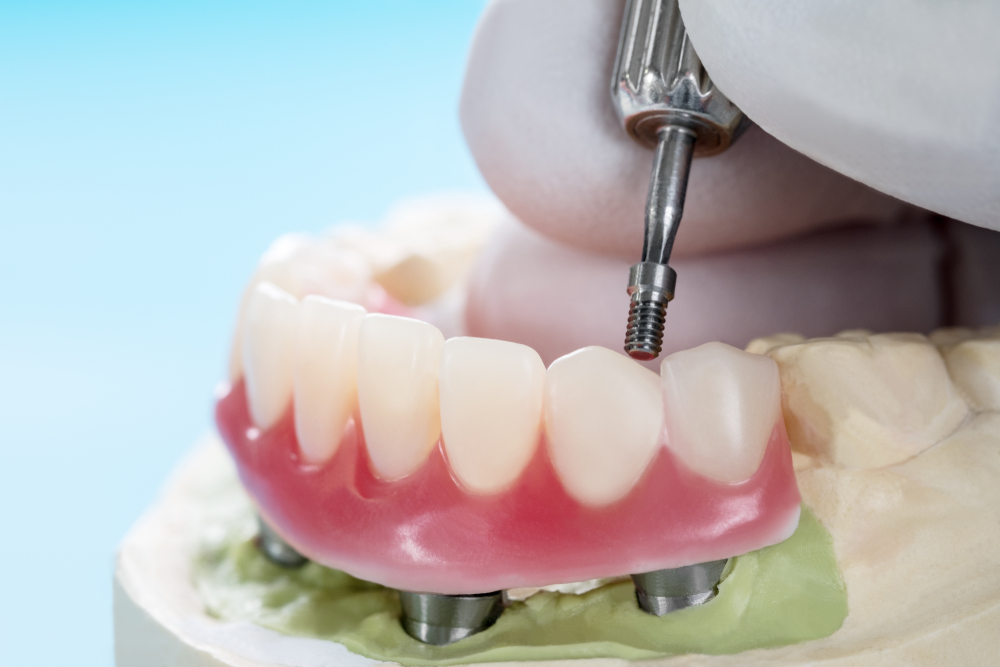 Implant-supported Dentures