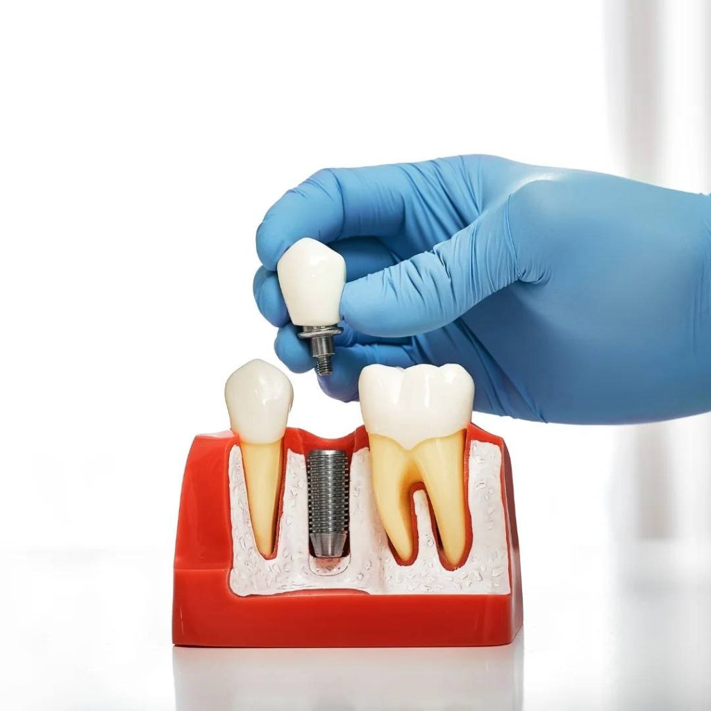 Implant Dentistry in London, ON